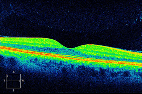 Post-treatment Photo: Visual Acuity 20/20