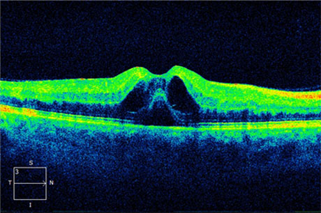 CRVO Pre-treatment Photo: Visual Acuity 20/60