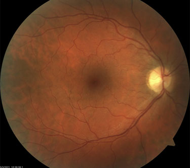 Fundus CRVO Post-treatment Photo: Visual Acuity 20/20