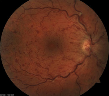 Fundus CRVO Pre-treatment Photo: Visual Acuity 20/60