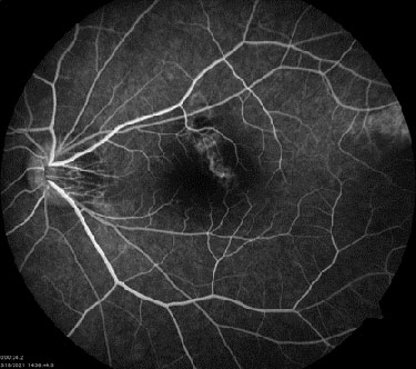 Multifocal choroiditis (MFC): FA 