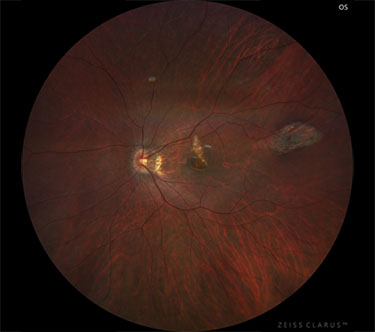 Multifocal choroiditis ( MFC): Wide angle view 