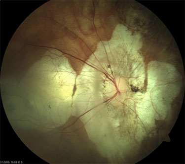 Myopic Degeneration 