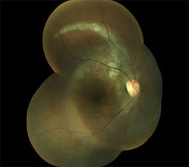 Polypoidal Choroidal Vasculopathy Post-treatment Photo: Visual Acuity 20/25