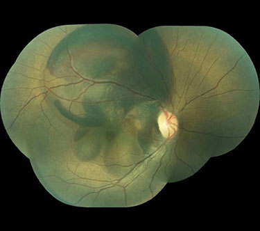 Polypoidal Choroidal Vasculopathy Pre-treatment Photo: Visual Acuity: Count Fingers