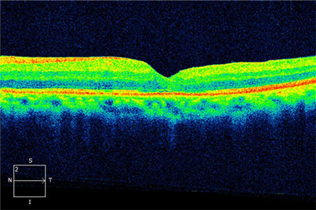 Macular Hole Post-op Photo: Visual Acuity 20/40