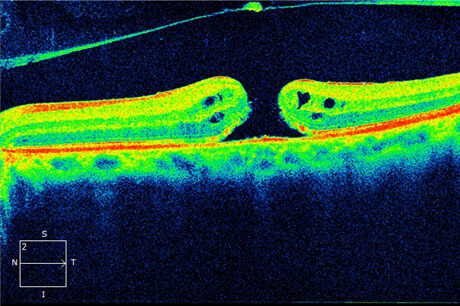 Macular Hole Pre-op Photo: Visual Acuity 20/400