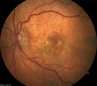 Wet Macular Degeneration